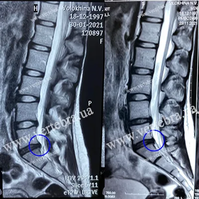 Удаление грыжи диска позвоночника L5-S1 справа аппаратом SpineGet