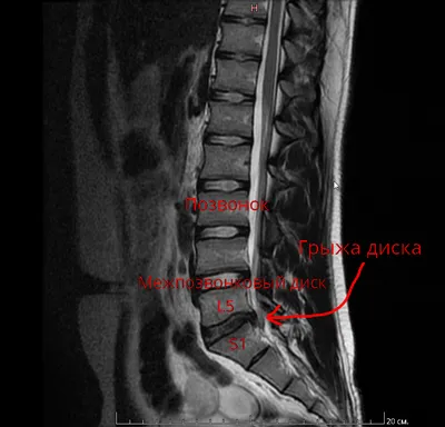 На МРТ написали \"грыжа межпозвонкового диска\". Сразу под нож? Отвечает  нейрохирург | Пикабу