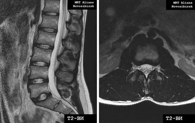 Магнитно-резонансная томография (МРТ) позвоночника