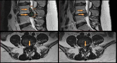 МРТ поясничного отдела позвоночника в Новосибирске – цены в клинике «МРТ  Альянс»