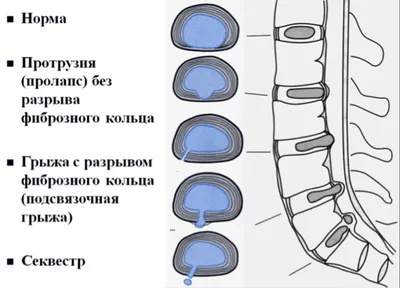 Секвестрированная грыжа позвоночника: симптомы, размеры, лечение,  последствия | Клиника Temed