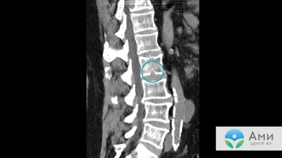 Грыжа позвоночника на МРТ: эффективная диагностика при выявлении грыжевых  образований