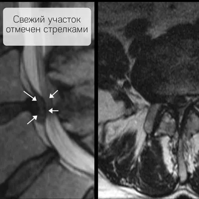 Магнитно-резонансная Томография (МРТ) Пояснично-крестцового Шипами:  Продемонстрировали Грыжа Межпозвоночного Диска В L3-L4 И L4-L5 Фотография,  картинки, изображения и сток-фотография без роялти. Image 20299032