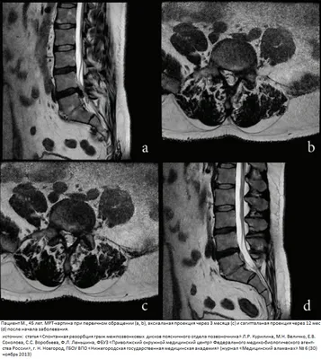 МРТ пояснично-крестцового отдела - Отделение КТ и МРТ НИИ СП им. Н.В.  Склифосовского