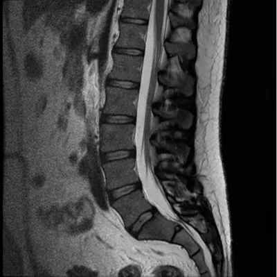 МРТ позвоночника (шейного, грудного, пояснично-крестцового отделов)