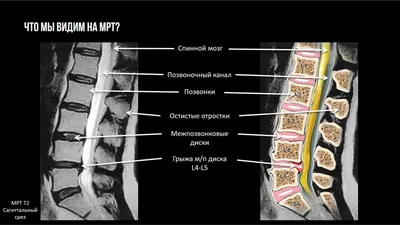 МРТ-разбор: грыжа (экструзия) межпозвонкового диска L5-S1 - YouTube
