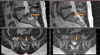 История грыжи диска L5-S1 с резорбцией | Smart Clinic