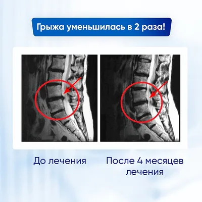 Межпозвонковая грыжа. Лечение грыжи позвоночника без операции в Киеве. -  Vertebra