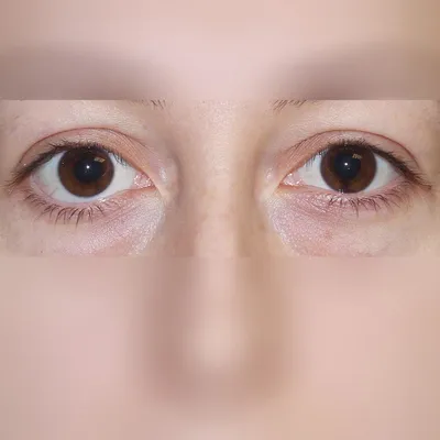 Как убрать нависшее веко над глазом | Клиника эстетической медицины  “Elevans”