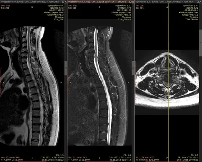 Межпозвонковая грыжа. Лечение грыжи позвоночника без операции в Киеве. -  Vertebra