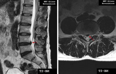 Грыжа позвоночника на МРТ - что покажет, признаки, снимки