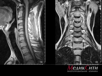 Результаты лечения межпозвонковых грыж и протрузий без операции, снимки МРТ  до и после, отзывы - Vertebra