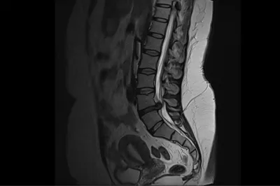 МРТ и КТ Рязань - Клиника-Сити - Секвестрированная грыжа позвоночника –  результат осложнения межпозвонковой грыжи. Заболевание приводит к тому, что  больной испытывает невыносимые боли в пояснице, отдающие в ногу и ягодицу.  Нередко