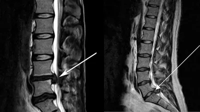 Магнитно-резонансная томография (МРТ) позвоночника