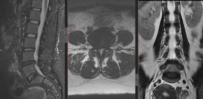 Что показывает МРТ позвоночника - противопоказания, расшифровка, процедура,  показания