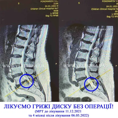 Грыжа на МРТ