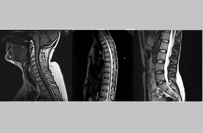 МРТ позвоночника - Медицинский центр «Юнимед» в Запорожье