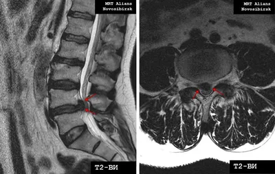 МРТ грудного, шейного, поясничного отдела - что показывает у женщин и  мужчин, как расшифровать заключение МРТ позвоночника