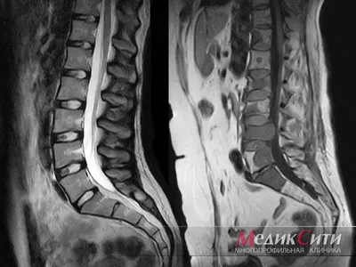 Грыжа позвоночника на МРТ снимках | MRT-V | Дзен