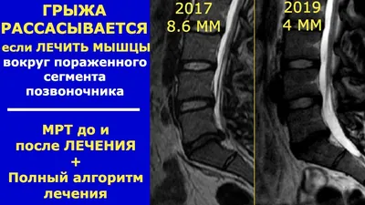 МРТ поясничного отдела позвоночника в Новосибирске – цены в клинике «МРТ  Альянс»