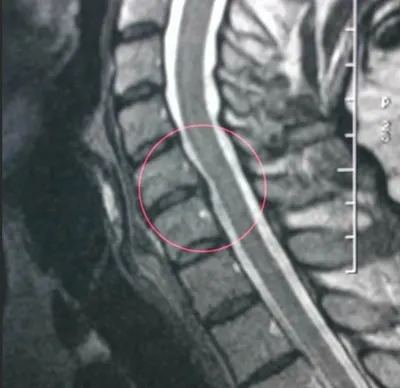 Stories of the treatment of intervertebral hernias and protrusions of our  patients without surgery, their MRI results and reviews - Vertebra