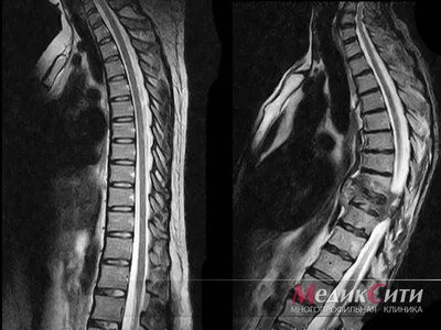 Магнитно-резонансная томография (МРТ) позвоночника