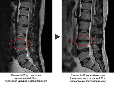 МРТ позвоночника (шейного, грудного, пояснично-крестцового отделов)