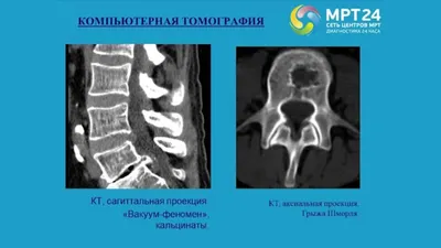 Рассказываем о новом успехе в борьбе с грыжей позвоночника!