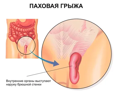 Паховая грыжа: у мужчин, женщин, детей; симптомы, лечение, операция