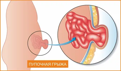 Паховая грыжа: малоинвазивное лечение в Одессе, ОМД Клиника - ОМД Клиника  2023