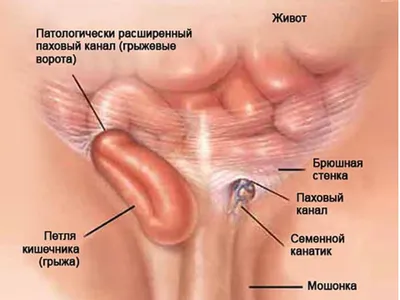 Паховая грыжа - причины развития заболевания, симптомы, диагностика и  лечение