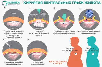 Почему возникает паховая грыжа: опасна ли она и всегда ли нужна операция? |  О здоровье: с медицинского на русский | Дзен