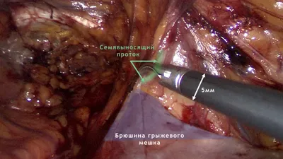 Паховая грыжа у мужчин и женщин: признаки, косая, прямая, чем опасна, какой  врач, лечение и операция