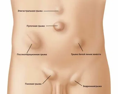 Можно вылечить паховую грыжу без операции