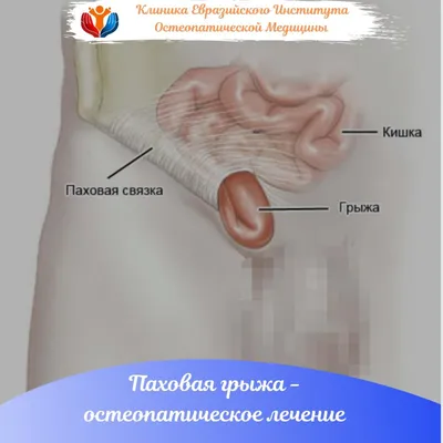 Пупочная грыжа: жалобы, причины появления и методы лечения | gormoniya