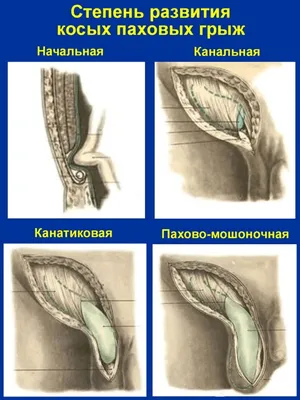 Паховая грыжа – остеопатическое лечение » Остеопатическая ассоциация  Кыргызской Республики