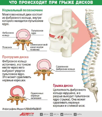 Пупочные грыжи у взрослых и детей: симптомы, лечение и операции