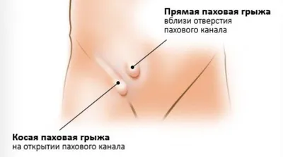 Косая паховая грыжа - причины, симптомы, лечение, операция. - Хирург К. В.  Пучков