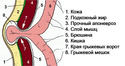 Паховая грыжа: симптомы, диагностика, лечение | gormoniya