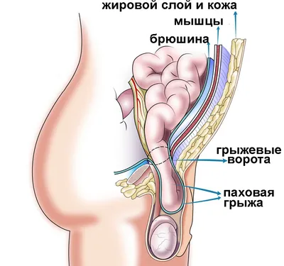 Грыжи передней брюшной стенки