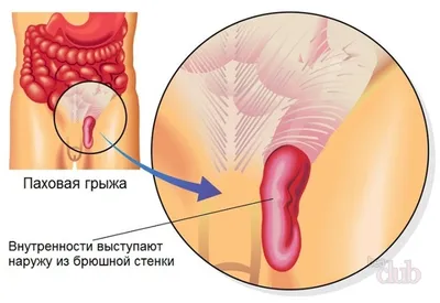 Паховая и бедренная грыжа - Новая мировая хирургия