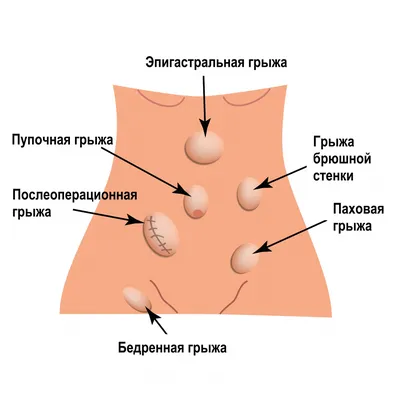 Паховая грыжа - Расстройства пищеварения - Справочник MSD Версия для  потребителей