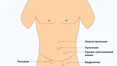 Можно вылечить паховую грыжу без операции