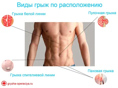 Паховая грыжа: причины, симптомы и хирургическое лечение в Москве в ФНКЦ  ФМБА