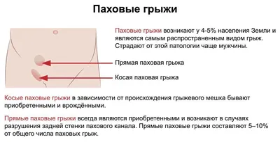 Паховая грыжа