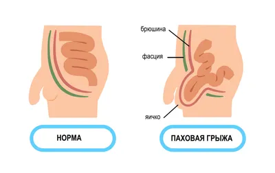 Хирургическое удаление грыжи в Киеве: стоимость удаления грыжи в клинике  Оксфорд Медикал