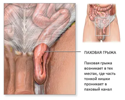 Реабилитация после операции паховой грыжи у мужчин и женщин