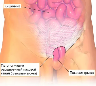 Паховая грыжа в Калининграде: операция, лечение и восстановление, цены и  отзывы на сайте