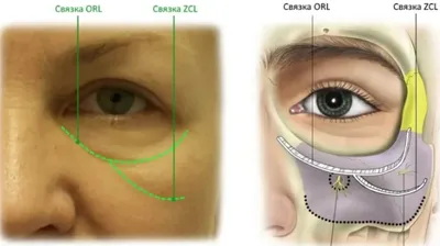 Как с помощью пластики век удалить мешки и грыжи под глазами. Нюансы  реабилитации