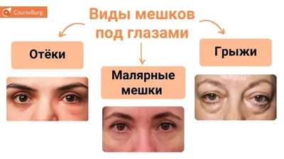 Удаляем жировые грыжи под глазами | Клиника косметологии и пластической  хирургии effi | Дзен
